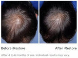 iRestore Laser Hair Growth System Hair Loss Treatment Regrowth Therapy NEW